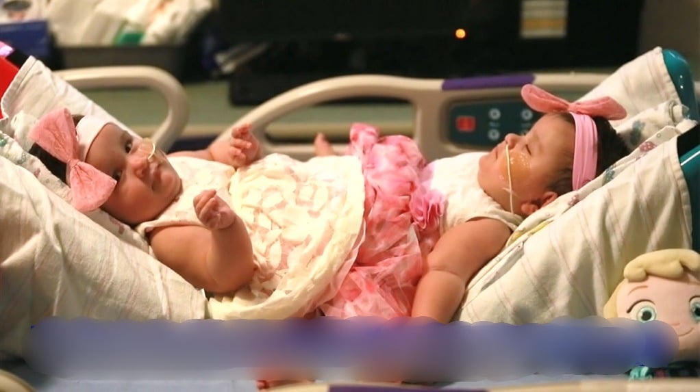 分割后曾被警告无法行走 连体婴10年后参加啦啦队比赛