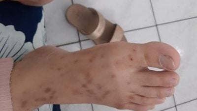 女子脚痒数月求医无果 医生最后从凉鞋找到病因！