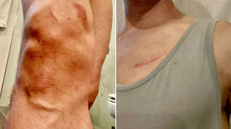 *已签发*柔：狮城二三事：晨跑时遭脚车撞倒  狮城文社青部长膝盖瘀伤