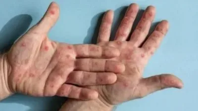 卫部：现新感染群 一家四口染M痘