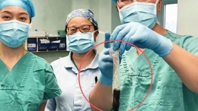 四川醉汉打赌吞下打火机 30年后医生用安全套取出