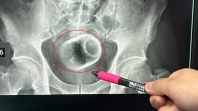 男无法解便就医惊见肛门塞8公分高陶瓷杯　剖肚取出