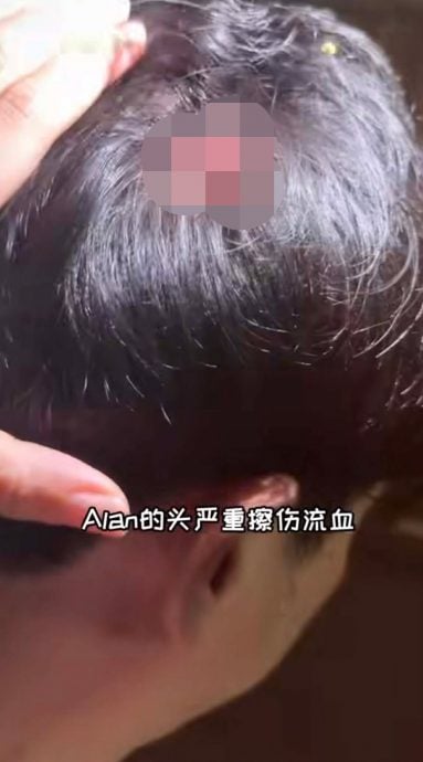 袁锦伦夫妇车祸后脑遭重击 林佩琦惊呼与死神擦肩而过