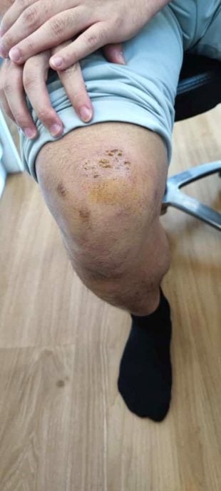 请签发-大都会/物理治疗师被匪徒抢项链,追匪时被拖了5、6杪,手脚受伤/4图