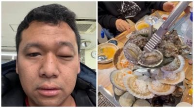 韩国吃海鲜惹祸！ 大马男脸肿入院花了RM1500