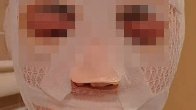 恐怖情人！怕女友移情别恋 竟趁她熟睡滚水泼脸毁容！