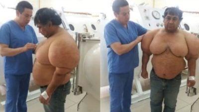 身体严重变形手臂肿胀 潜水员患“减压症”如充气气球