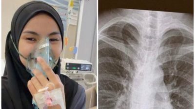 刚跑完半马 持续咳嗽1个月 女子确诊肺部感染！