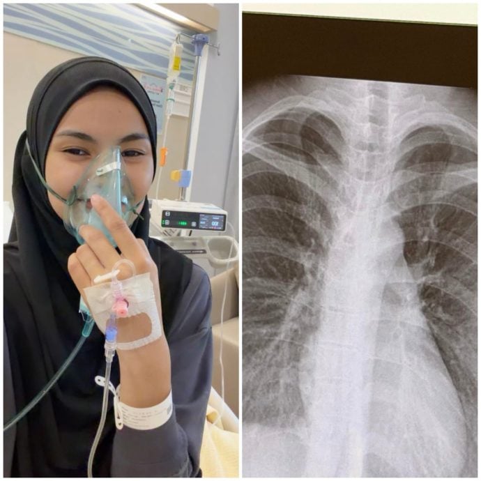 持续咳嗽1个月竟是肺部感染! 女子刚跑完半马确诊