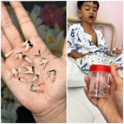 男童一次拔12蛀牙 就因这个坏习惯！