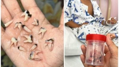 男童一次拔12蛀牙 就因这个坏习惯！