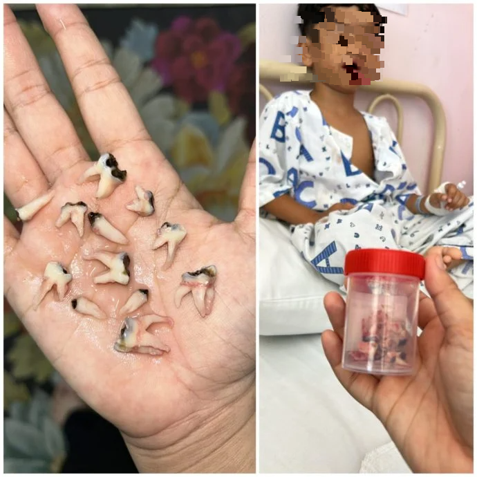 男童一次性拔12颗蛀牙 一坏习惯导致