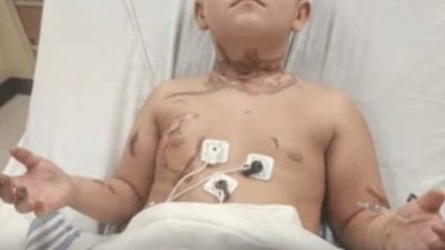 男童翻身不慎颈链卡充电器缝隙 触电烧伤需植皮险丧命