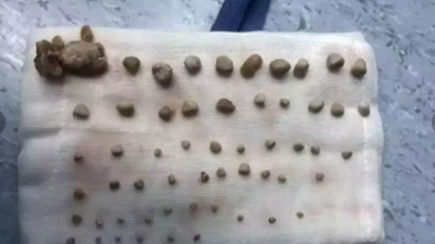 9岁童肾长56粒结石 医生揭妈妈溺爱助养成恶习惹祸