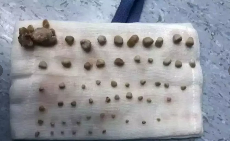 郑州9岁童肾长56粒结石 医生揭妈妈溺爱助养成恶习惹祸