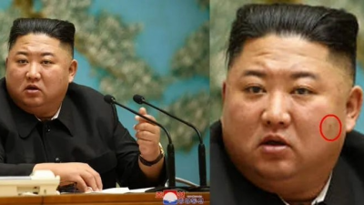 金正恩脸上长满“诡异肉芽” 和10年前对比　再爆健康疑云