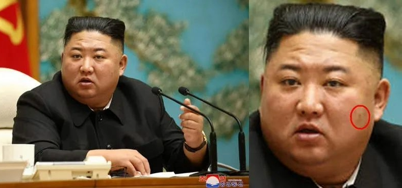 金正恩脸上长满“诡异肉芽” 和10年前对比　再爆健康疑云