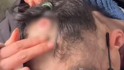 女大生癌症复发 父亲日夜奔波20小时为女筹医药费