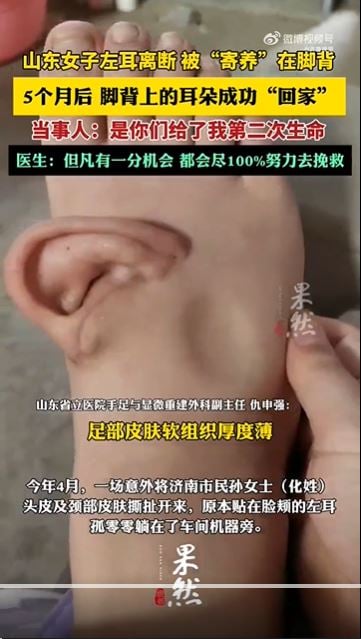 (已签发)女子断耳寄养脚背 5个月后成功“回家”